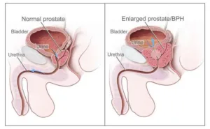 Diagram of a normal prostate and benign prostatic hyperplasia compressing the urethra