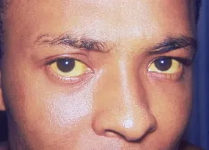 Close view of an eye with yellow jaundiced sclera