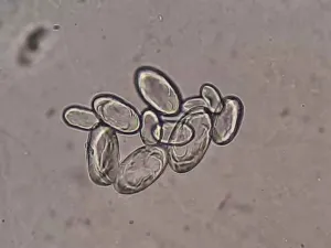 Oval calcium oxalate monohydrate crystals in urine sediment, the target of Phyllanthus niruri stone research