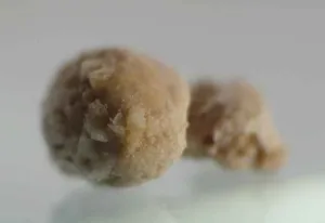 A small rough brown kidney stone about four millimetres across, the condition studied with Phyllanthus niruri