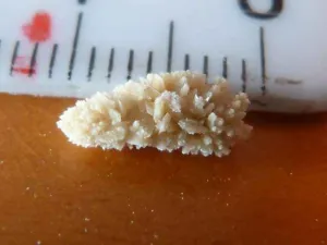Pale spiky kidney stone beside a millimetre ruler, the condition for which Phyllanthus niruri is taken